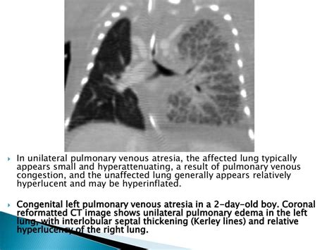 Unilateral Hyperlucent Lung In Children