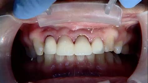 Here are 10 of the top. The Benefits of CAD CAM Restorations - YouTube