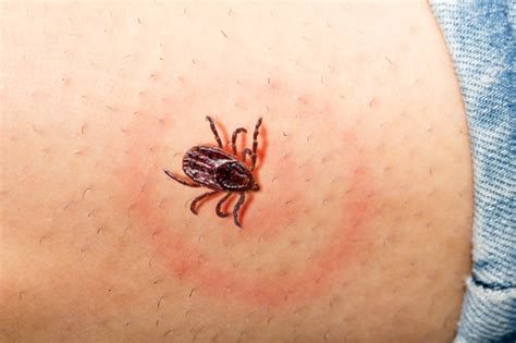 How To Recognize A Tick Bite Solution Cimex