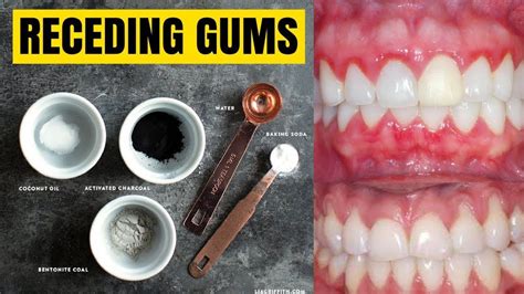 While there are lots of people who support the usage of receding gums reverse dentistry as a part of a regular oral hygiene regime, there are also others that advise. How To Fix Receding Gums Without Surgery - unugtp