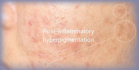 How To Get Rid Of Post Inflammatory Hyperpigmentation Pih Art Of