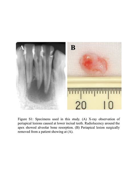 It is usually contraindicated after surgical procedures. Throbbing Pain After Root Canal Reddit - Root Canal Toothache