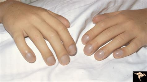 Cyanotic Heart Disease With Clubbing Of Fingernails Eccles Health