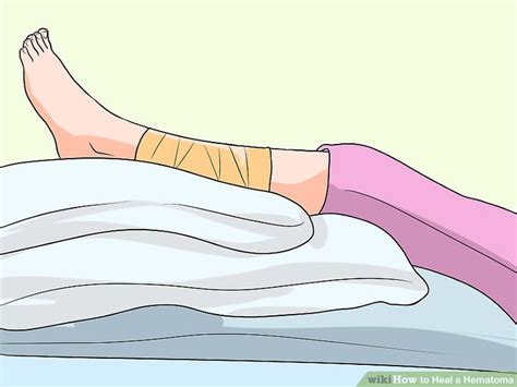 Oct 22, 2013 · veins injured below the skin with a hematoma will take about 7 to 10 days to heal while a vein bleeding from the skin will usually stop with direct pressure and heal within 5 to 7 days. How to Heal a Hematoma: 10 Steps (with Pictures) - wikiHow
