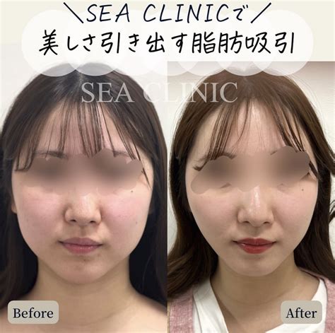 美しさ引き出す脂肪吸引 Sea Clinic −シークリニック 銀座― 理想を叶える小顔治療