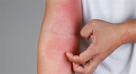 D A Mundial De La Dermatitis At Pica Todo Lo Que Necesitas Saber Sobre