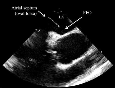 Tee Showing Atrial Septal Aneurysm And The Pfo La Left Atrium Ra