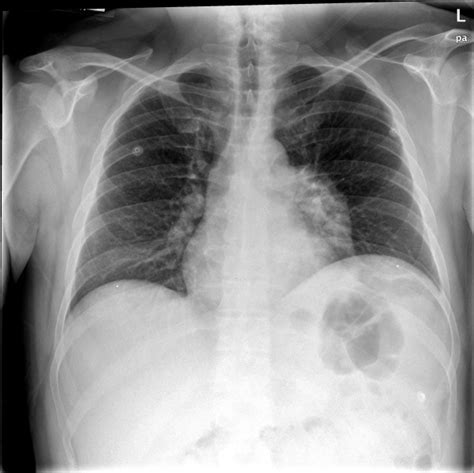 Chest X Ray Demonstrating A Left Hilar Mass Download Scientific Diagram