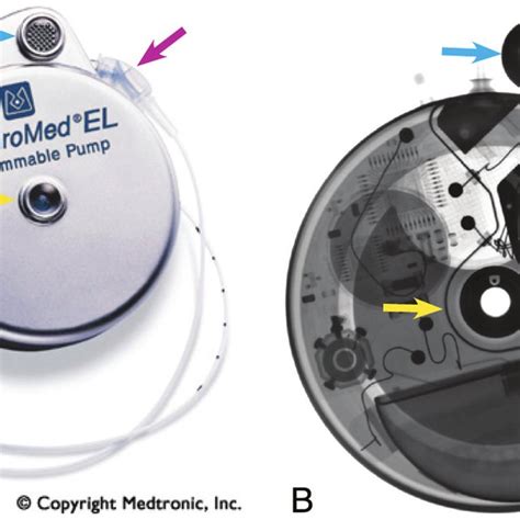Pdf Imaging Evaluation Of Intrathecal Baclofen Pump Catheter Systems