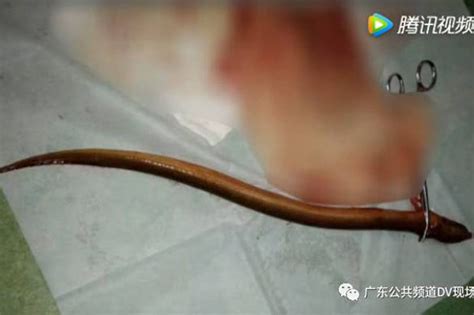 Constipated Chinese Man Nearly Dies After Pushing 50cm Eel Up His Bum