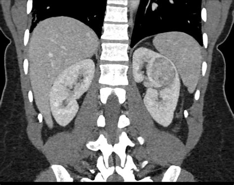 Oncocytoma Left Kidney Kidney Case Studies Ctisus Ct Scanning