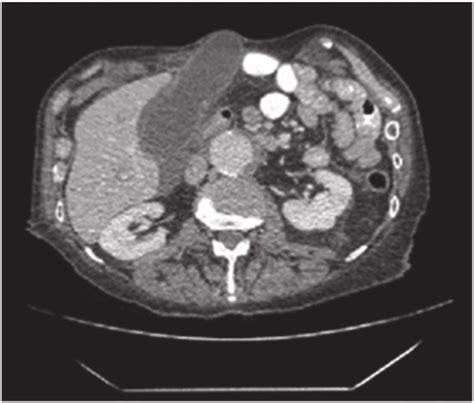 The Axial Section Of The Abdomenpelvis Ct Scan Illustrating Our