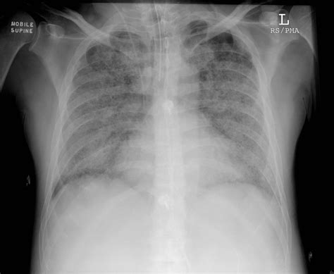 Ards Chest X Ray Findings