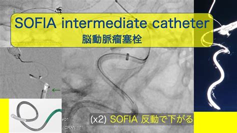 Sofia Intermediate Catheter 脳動脈瘤コイル塞栓 中間カテーテルの 反動 Youtube