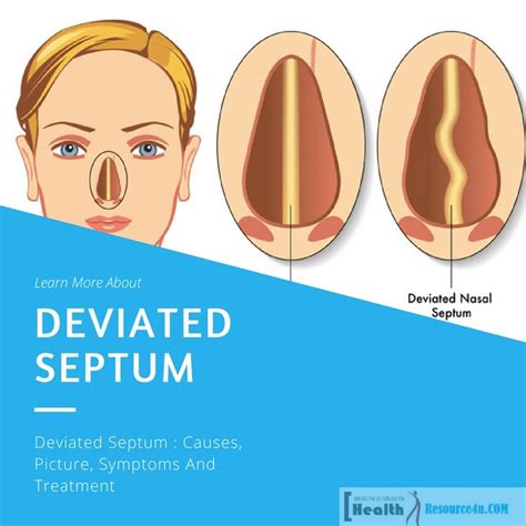 Deviated Septum Causes Picture Symptoms And Treatment