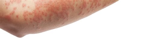 Common Skin Rashes Pictures Causes And Treatments United States