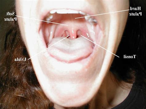 Normal Roof Of Mouth Photos