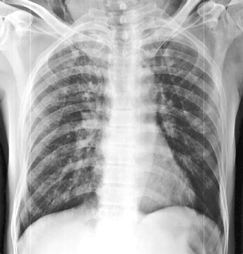 Chest Radiograph Showing Right Upper Zone Consolidation With Bilateral