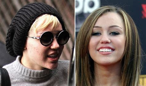 10 Beautiful Celebrities With Surprising Acne Scars