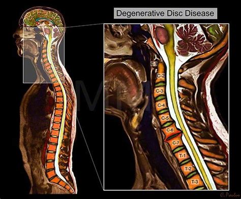 Reference Color Mri Cervical Spine Disc Degeneration Spinal Stenosis