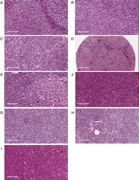 Pathological Assessment Of Follicular Lymphoma Fl And Mantle Cell
