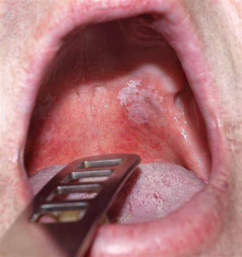 Leukoplakia Concise Medical Knowledge