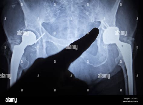 X Ray Scan Image Of Hip Joints With Orthopedic Hip Joint Replacement