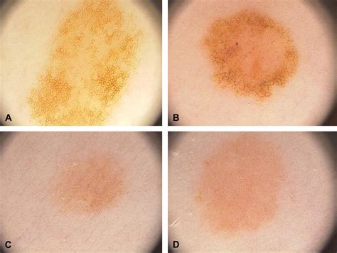 Dermatoscopy of pigmented melanocytic nevi in patients ...