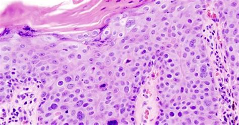 But having lcis increases your risk of breast cancer and makes it more likely that you may develop invasive breast cancer. Bowen's disease (squamous cell carcinoma in situ ...