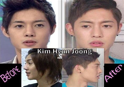Kim Hyun Joong Plastic Surgery Before And After Photos He Is The Only
