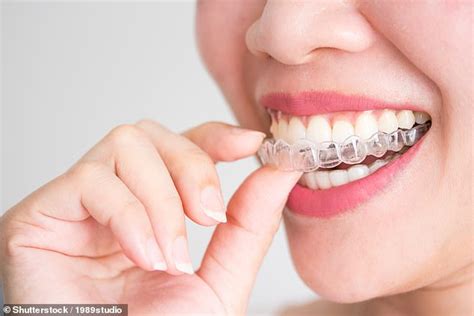 You Can Save A Fortune Buying Braces Online But They Might Not Give