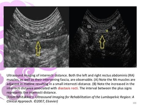 Rehabilitative Ultrasound Imaging A Musculoskeletal Perspective