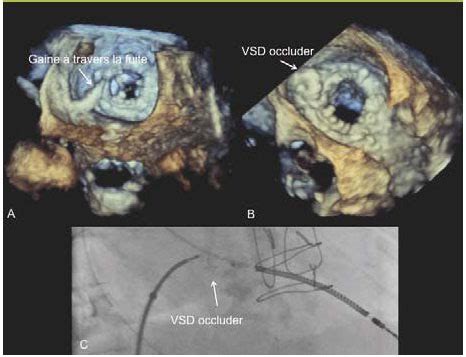 En analysant plus de 7600 études sur le prolapsus de la valve mitrale, ils ont découvert que 12 les troubles du rythme cardiaque pourraient donc être la raison pour laquelle les prolapsus de la valve. Fuite paravalvulaire après chirurgie cardiaque : quelle ...