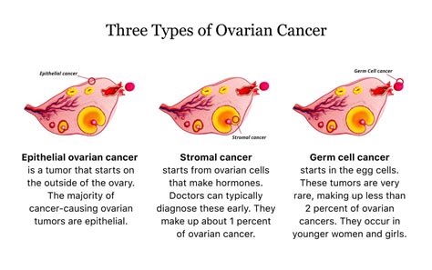 Ovarian Cancer Health Guide Symptoms Types Treatment