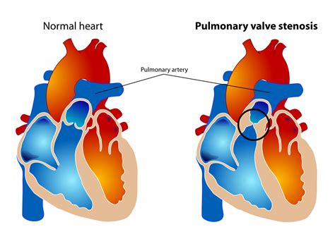 Estenose Pulmonar Pode Matar