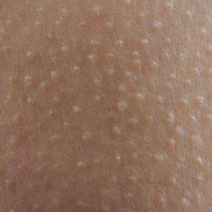 Our Expert Guide To Keratosis Pilaris Aka Chicken Skin The Naked