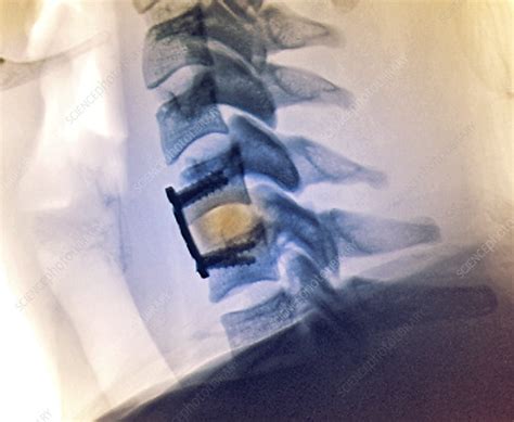 Cervical Vertebral Implant And Repair X Ray Stock Image C0403344