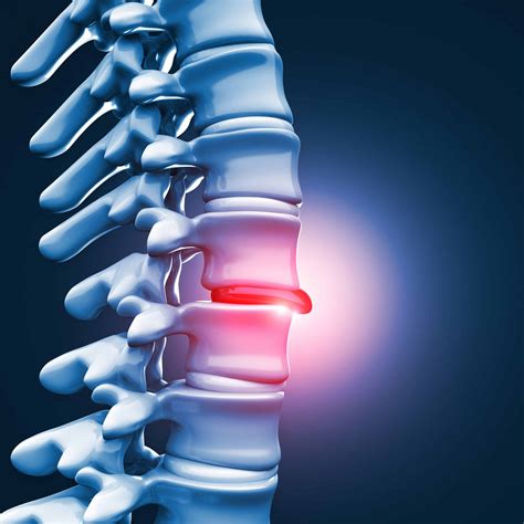 What Causes A Herniated Disc And How Can It Be Treated Becker Spine