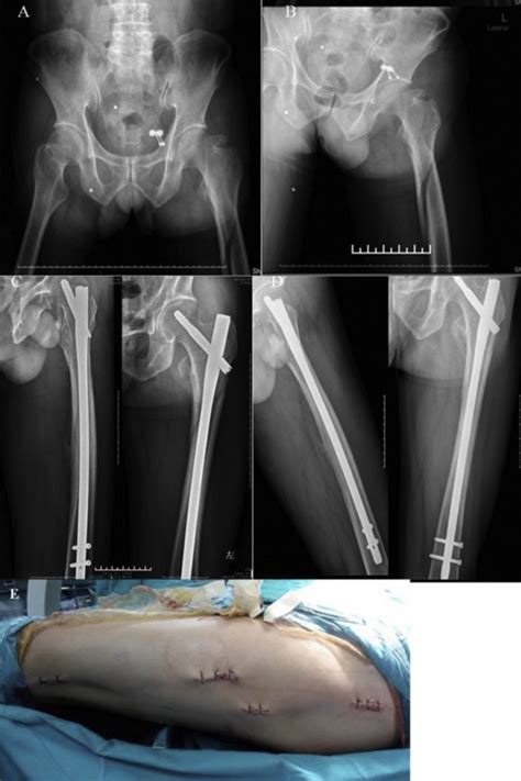 A B Subtrochanteric Fracture Of Left Femur Treated By Limited Open Download Scientific