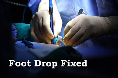 Foot Drop Surgically Fixed By Releasing Common Peroneal Nerve