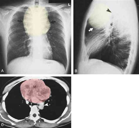 Tumor Benign Lung Tumors