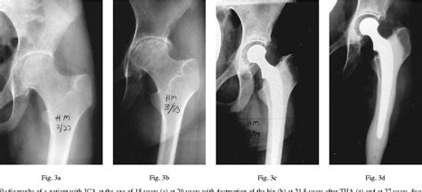 Pdf Survivorship Of The Charnley Total Hip Arthroplasty In Juvenile