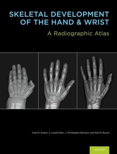 Skeletal Development Of The Hand And Wrist A Radiographic Atlas And