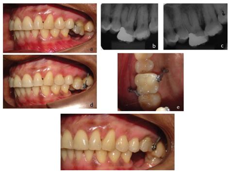 Scielo Brasil Molar Intrusion With Orthodontic Mini Implants Case Reports Molar Intrusion