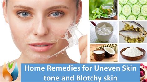 Home Remedies For Uneven Skin Tone And Blotchy Skin Youtube