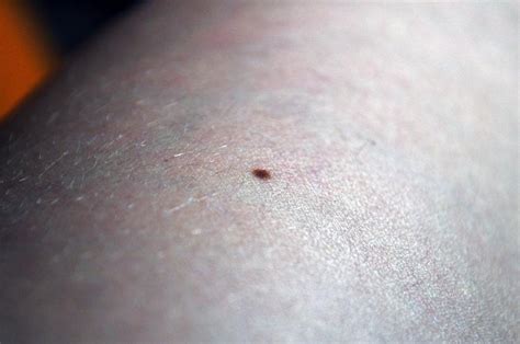 Moles Linked To Risk For Breast Cancer
