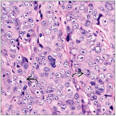 Histologic Grade Basicmedical Key