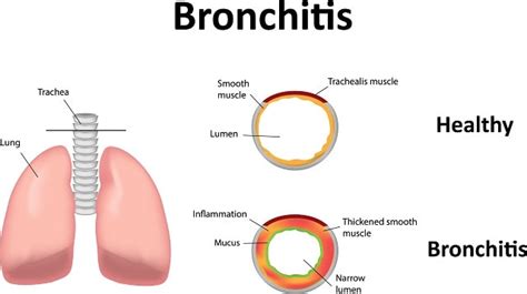 Acute Bronchitis Treatment Symptoms Causes And Preventions
