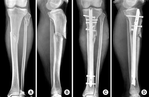 Intramedullary Nailing Of Proximal Tibial Fractures