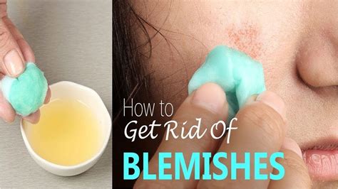 How To Reduce Blemishes Home Remedies For Blemishes Youtube